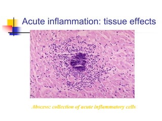 Acute inflammation: tissue effects
Abscess: collection of acute inflammatory cells
 