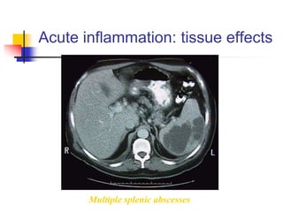 Acute inflammation: tissue effects
Multiple splenic abscesses
 