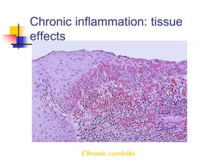 Chronic inflammation: tissue
effects
Chronic cervicitis
 