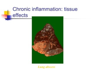 Chronic inflammation: tissue
effects
Lung abscess
 