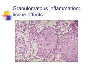 Granulomatous inflammation:
tissue effects
 