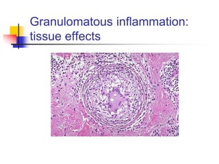 Granulomatous inflammation:
tissue effects
 