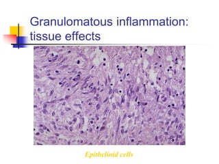 Granulomatous inflammation:
tissue effects
Epithelioid cells
 