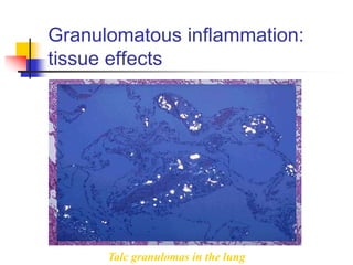 Granulomatous inflammation:
tissue effects
Talc granulomas in the lung
 