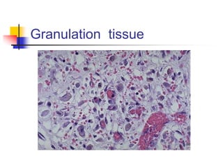 Granulation tissue
 