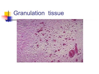 Granulation tissue
 