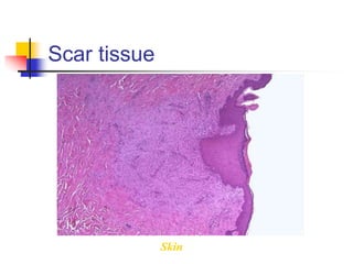 Scar tissue
Skin
 