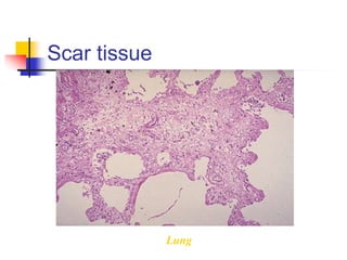 Scar tissue
Lung
 