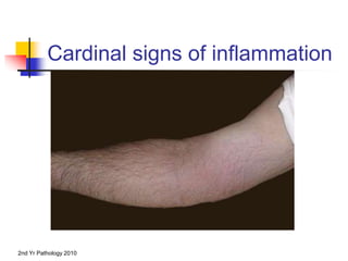 2nd Yr Pathology 2010
Cardinal signs of inflammation
 