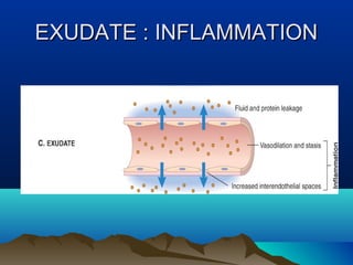EXUDATE : INFLAMMATIONEXUDATE : INFLAMMATION
 