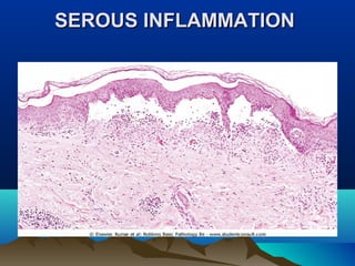 SEROUS INFLAMMATIONSEROUS INFLAMMATION
 