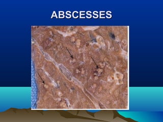 ABSCESSESABSCESSES
 