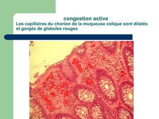 congestion active
Les capillaires du chorion de la muqueuse colique sont dilatés
et gorgés de globules rouges
 