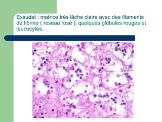 Exsudat : matrice très lâche claire avec des filaments
de fibrine ( réseau rose ), quelques globules rouges et
leucocytes.
 