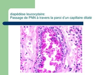 diapédèse leucocytaire:
Passage de PNN à travers la paroi d’un capillaire dilaté
 