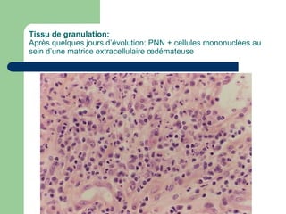 Tissu de granulation:
Après quelques jours d’évolution: PNN + cellules mononuclées au
sein d’une matrice extracellulaire œdémateuse
 