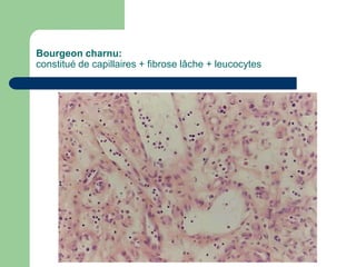 Bourgeon charnu:
constitué de capillaires + fibrose lâche + leucocytes
 