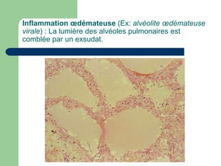 Inflammation œdémateuse (Ex: alvéolite œdémateuse
virale) : La lumière des alvéoles pulmonaires est
comblée par un exsudat.
 