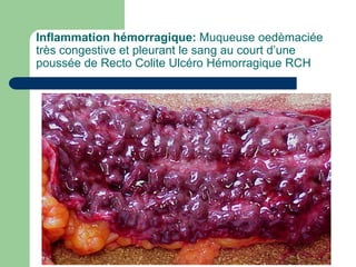 Inflammation hémorragique: Muqueuse oedèmaciée
très congestive et pleurant le sang au court d’une
poussée de Recto Colite Ulcéro Hémorragique RCH
 