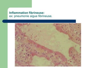 Inflammation fibrineuse:
ex: pneumonie aigue fibrineuse.
 