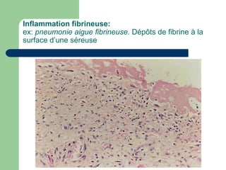Inflammation fibrineuse:
ex: pneumonie aigue fibrineuse. Dépôts de fibrine à la
surface d’une séreuse
 