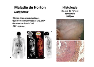 Maladie de Horton
Diagnostic
•Signes cliniques céphaliques
•Syndrome inflammatoire (VS, CRP)
•Examen du Fond d’œil
•TEP –s...
