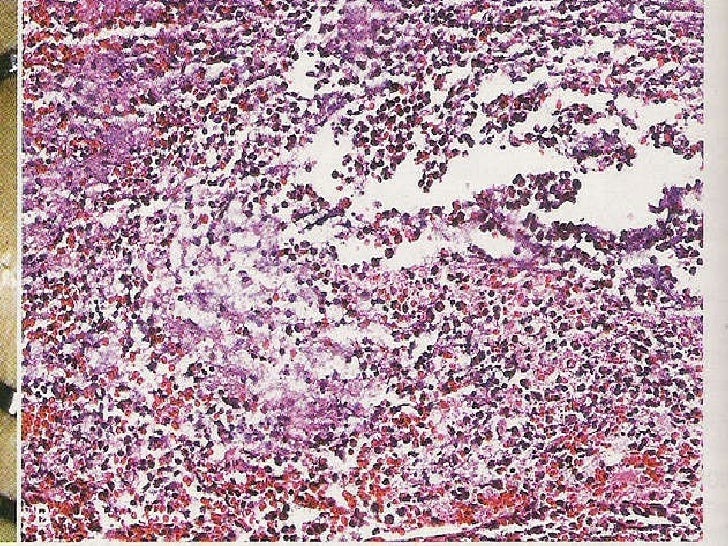 Inflammation