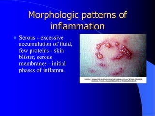 Inflammation lecture | PPT