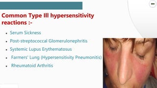 SLIDESMANIA.COM
SLIDESMANIA.COM
● Serum Sickness
● Post-streptococcal Glomerulonephritis
● Systemic Lupus Erythematosus
● Farmers' Lung (Hypersensitivity Pneumonitis)
● Rheumatoid Arthritis
Common Type Ill hypersensitivity
reactions :-
 