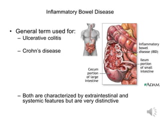 Inflammatory Bowel Disease
• General term used for:
– Ulcerative colitis
– Crohn’s disease
– Both are characterized by extraintestinal and
systemic features but are very distinctive
 