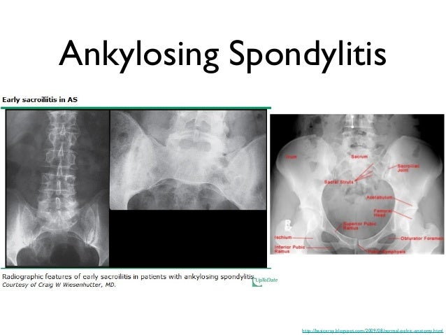 Inflammatory arthritis
