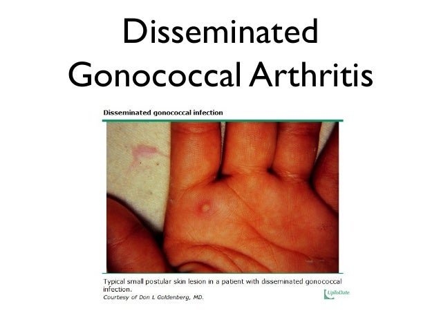 Gonococcal Arthritis Dermatitis – FAHDZ