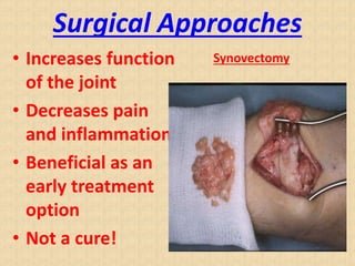 Surgical Approaches
• Increases function
of the joint
• Decreases pain
and inflammation
• Beneficial as an
early treatment
option
• Not a cure!
Synovectomy
 