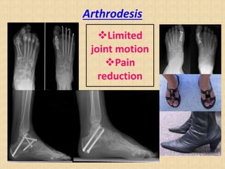 Arthrodesis
Limited
joint motion
Pain
reduction
 
