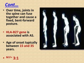 Cont…
• Over time, joints in
the spine can fuse
together and cause a
fixed, bent-forward
posture.
• HLA-B27 gene is
associated with AS.
• Age of onset typically
between 15 and 35
years.
• M:F= 3:1
 