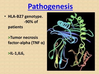Pathogenesis
• HLA-B27 genotype.
-90% of
patients
>Tumor necrosis
factor-alpha (TNF α)
>IL-1,IL6,
 