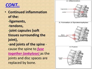 CONT..
• Continued inflammation
of the:
-ligaments,
-tendons,
-joint capsules (soft
tissues surrounding the
joint),
-and joints of the spine -
cause the spine to fuse
together (ankylose) as the
joints and disc spaces are
replaced by bone.
 