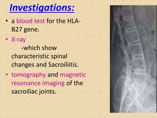 Investigations:
• a blood test for the HLA-
B27 gene.
• X-ray
-which show
characteristic spinal
changes and Sacroiliitis.
• tomography and magnetic
resonance imaging of the
sacroiliac joints.
 