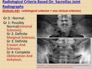 Radiological Criteria Based On Sacroiliac Joint
Radiographs
(Definite AS= radiological criterion + one clinical criterion)
Gr 0 : Normal.
Gr 1: Possibly
Normal(minimal
Sclerosis).
Gr 2: Definite
Marginal Sclerosis.
Gr 3: Definite
Erosion And
Sclerosis.
Gr 4: Complete
Obliteration And
Ankylosis.
 