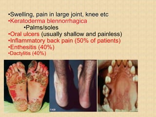 •Swelling, pain in large joint, knee etc
•Keratoderma blennorrhagica
•Palms/soles
•Oral ulcers (usually shallow and painless)
•Inflammatory back pain (50% of patients)
•Enthesitis (40%)
•Dactylitis (40%)
 
