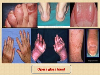 Opera glass hand
 