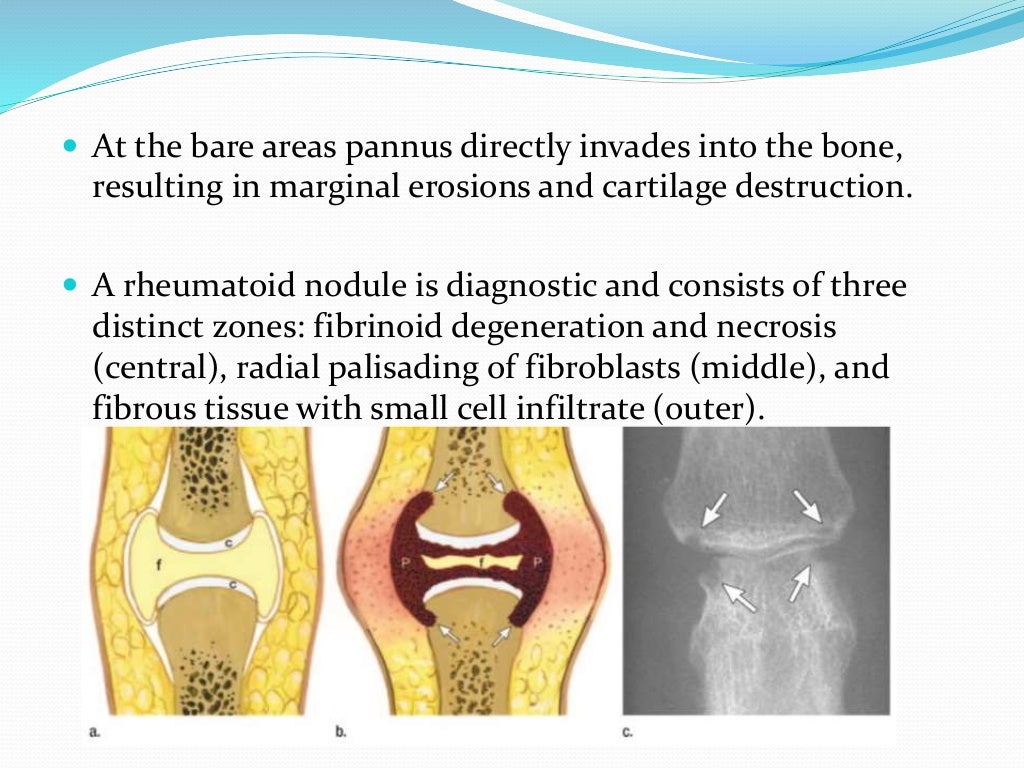 Inflammatory Arthritis