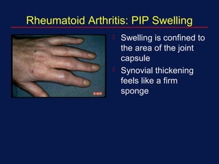 Rheumatoid Arthritis: PIP Swelling
 Swelling is confined to
the area of the joint
capsule
 Synovial thickening
feels like a firm
sponge
 