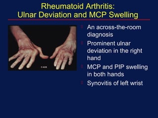 Rheumatoid Arthritis:
Ulnar Deviation and MCP Swelling
 An across-the-room
diagnosis
 Prominent ulnar
deviation in the right
hand
 MCP and PIP swelling
in both hands
 Synovitis of left wrist
 