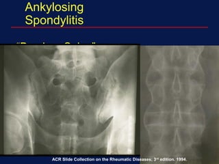 Ankylosing
Spondylitis
“Bamboo Spine”
Repeated process of healing
and bone formation leads to
formation of syndesmophytes
‘bone bridges’
ACR Slide Collection on the Rheumatic Diseases; 3rd
edition. 1994.
 