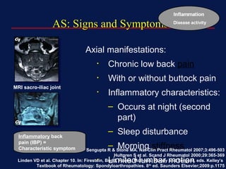 AS: Signs and SymptomsAS: Signs and Symptoms
Axial manifestations:
• Chronic low back pain
• With or without buttock pain
• Inflammatory characteristics:
– Occurs at night (second
part)
– Sleep disturbance
– Morning stiffness
• Limited lumbar motion
Sengupta R & Stone MA. Nat Clin Pract Rheumatol 2007;3:496-503
Hultgren S et al. Scand J Rheumatol 2000;29:365-369
Linden VD et al. Chapter 10. In: Firestein, Budd, Harris, McInnes, Ruddy and Sergent, eds. Kelley’s
Textbook of Rheumatology: Spondyloarthropathies. 8th
ed. Saunders Elsevier;2009:p.1175
Inflammatory back
pain (IBP) =
Characteristic symptom
MRI sacro-iliac joint
 