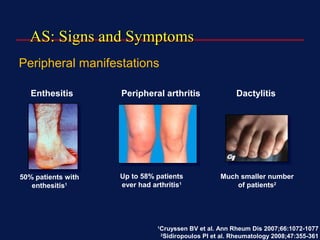 Peripheral manifestations
Enthesitis Peripheral arthritis Dactylitis
AS: Signs and SymptomsAS: Signs and Symptoms
50% patients with
enthesitis1
1
Cruyssen BV et al. Ann Rheum Dis 2007;66:1072-1077
2
Sidiropoulos PI et al. Rheumatology 2008;47:355-361
Up to 58% patients
ever had arthritis1
Much smaller number
of patients2
 