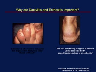 Why are Dactylitis and Enthesitis Important?
The first abnormality to appear in swollen
joints associated with
spondyloarthropathies is an enthesitis2
Likelihood of erosions is higher
for digits with dactylitis than
those without1
1
Brockbank. Ann Rheum Dis 2005;62:188-90;
2
McGonagle et al. The Lancet 1998;352.
 