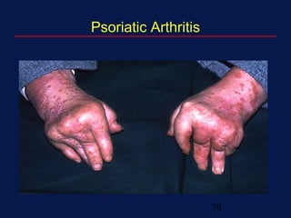 30
Psoriatic Arthritis
 