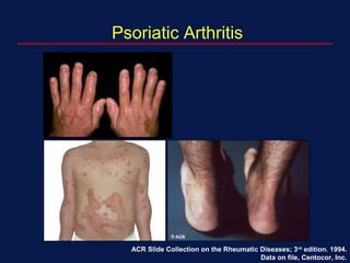 Psoriatic Arthritis
ACR Slide Collection on the Rheumatic Diseases; 3rd
edition. 1994.
Data on file, Centocor, Inc.
 